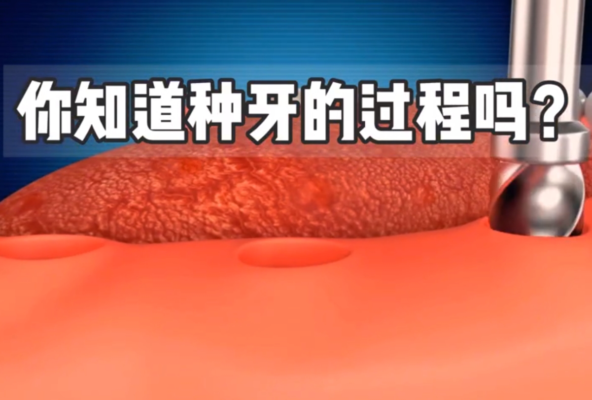 牙齿种植过程