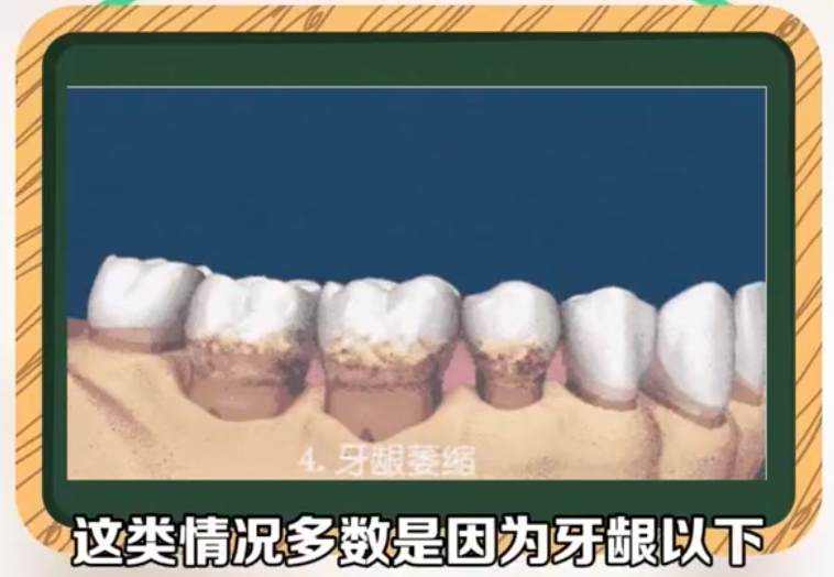 牙周炎怎么解决